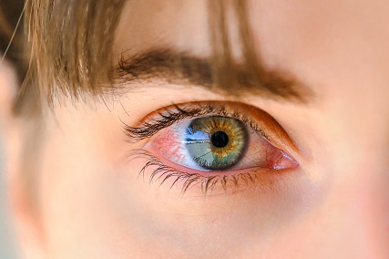 womans red eye upclose